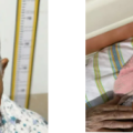 隨州市中心醫(yī)院：惡性包塊切除+自體皮移植，87歲老奶奶變美了！