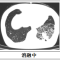 隨州市中心醫(yī)院：【特色技術(shù)】微創(chuàng)技術(shù)新突破，冷凍消融治療精準(zhǔn)“凍殺”癌細(xì)胞