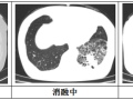 隨州市中心醫(yī)院：【特色技術(shù)】微創(chuàng)技術(shù)新突破，冷凍消融治療精準(zhǔn)“凍殺”癌細(xì)胞